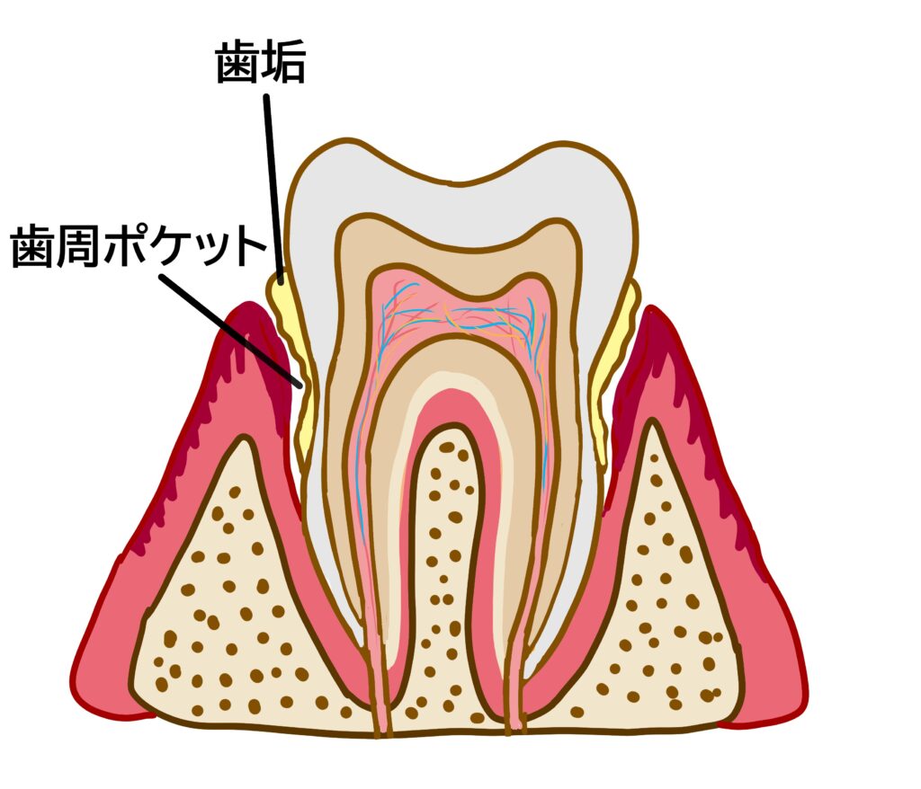 むし歯や歯周病の原因！「プラーク」とは | 知らないと損する歯の話