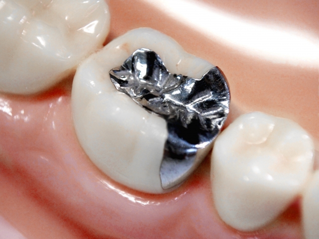 保険治療の銀歯はどのようにして作られるのか。銀歯作製の裏側