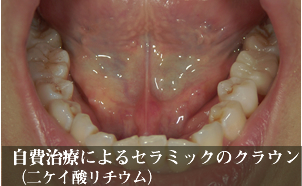 自費治療によるセラミックのクラウン